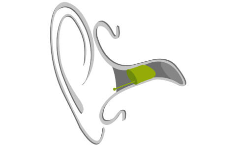 Grafik wie ein In-dem-Ohr Hörgerät im Ohr sitzt