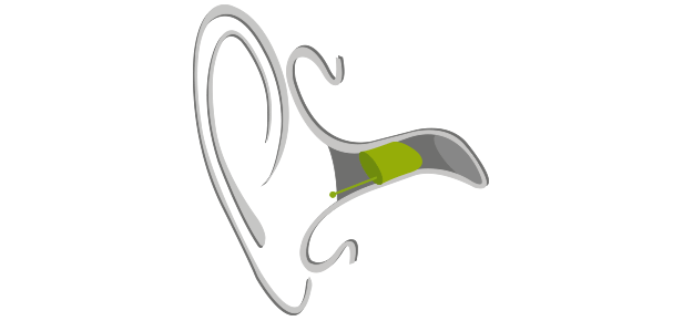 Grafik von einem Ohr in dem ein IdO Hörgerät sitzt